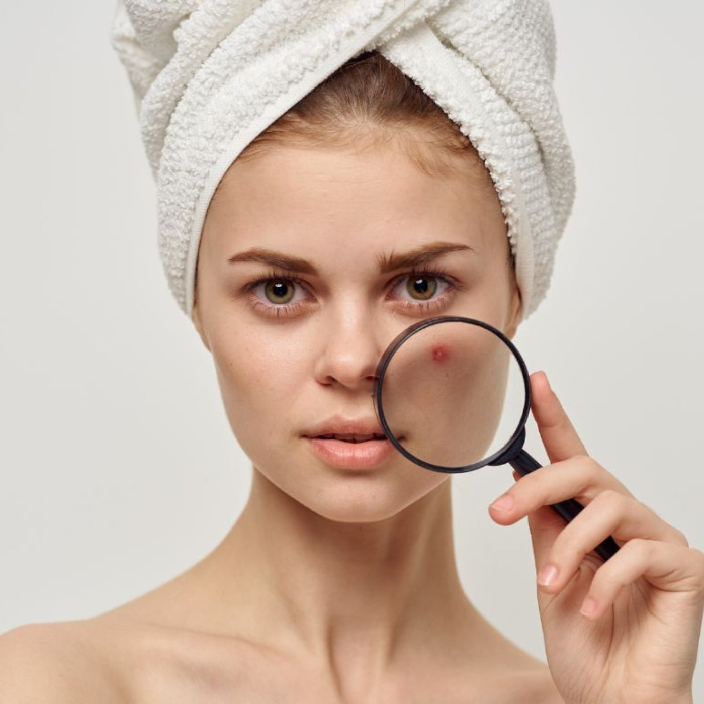 How To Get Rid of Acne Scars