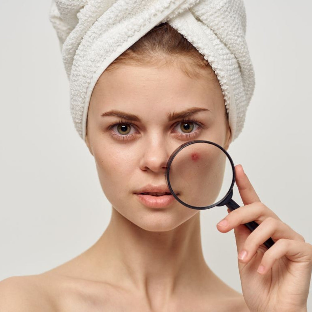 How To Get Rid of Acne Scars