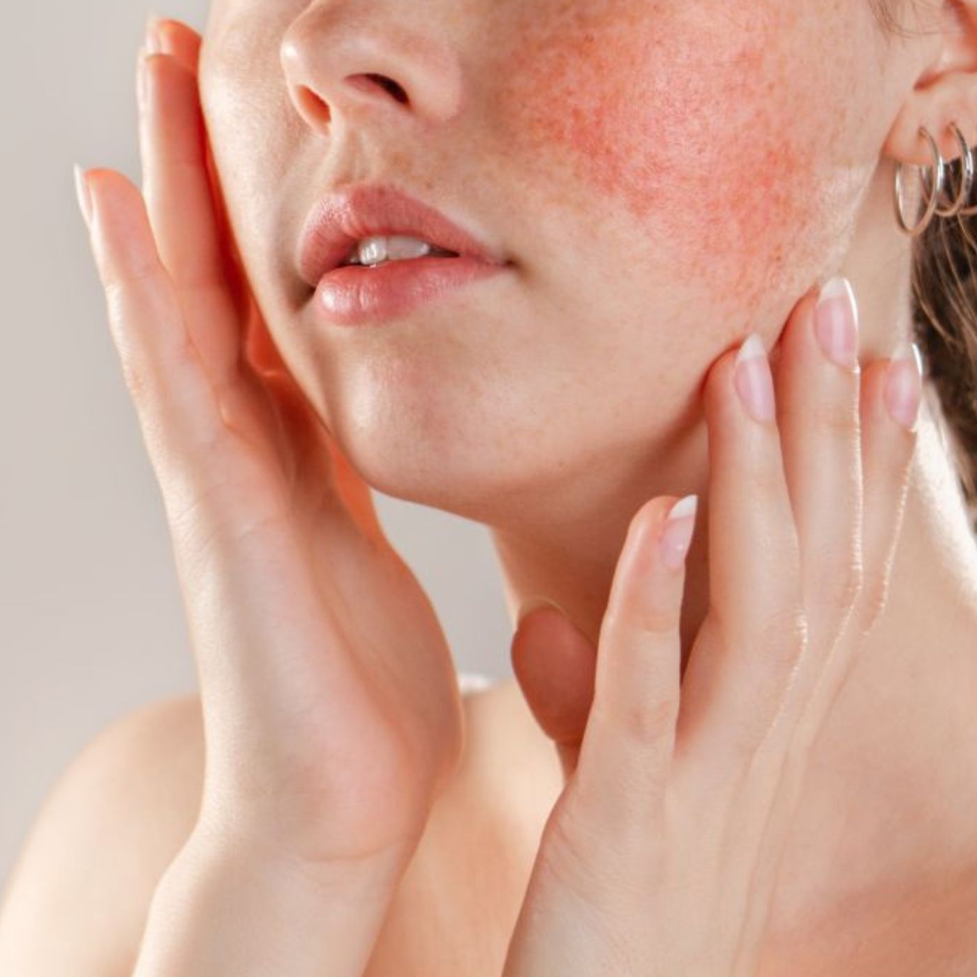 What is rosacea and how can you treat it?