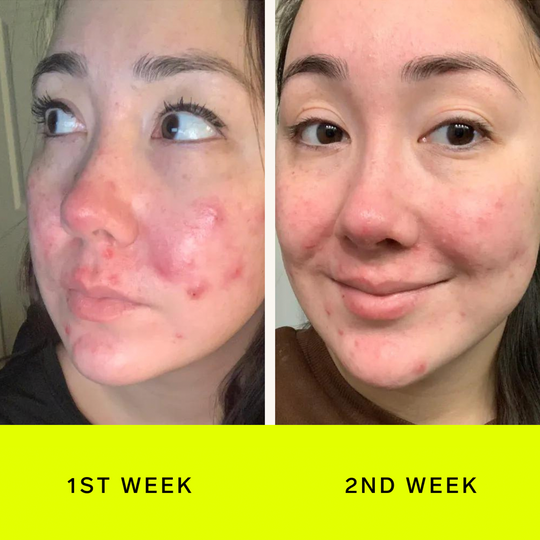 Saved my face from cystic acne.